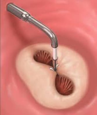 MitraClip Illustrated Example - Structural Heart Disease